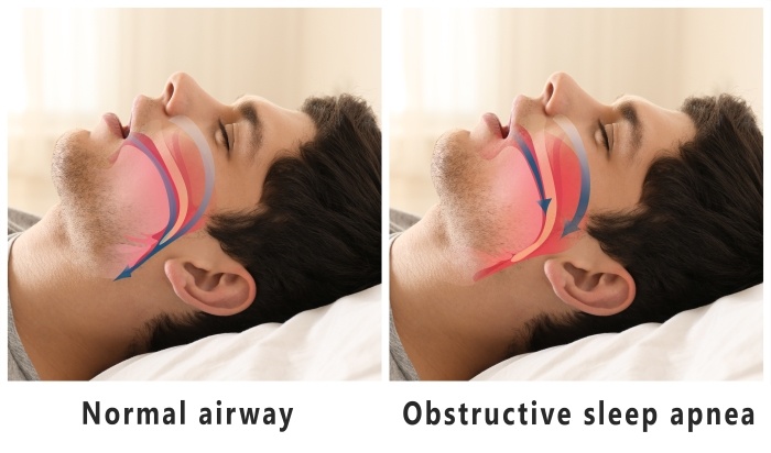 Normal Airway Vs Obstructive Sleep Apnea Texan Ent Specialists