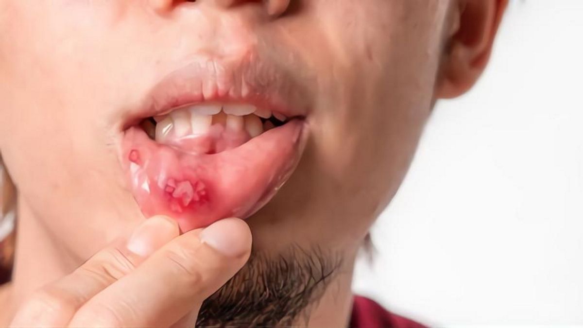 mouth-ulcers-symptoms-treatment-and-when-to-worry