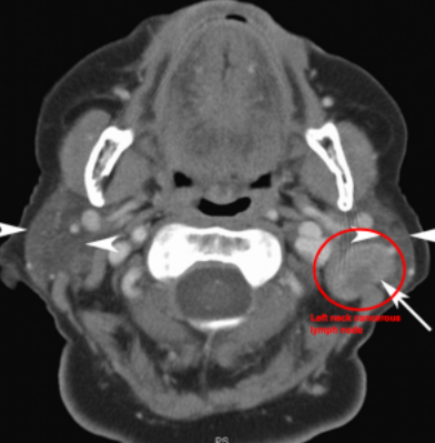 CT showing the cancerous left neck lymph node