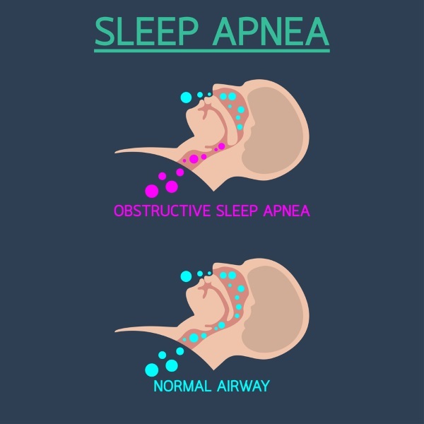 sleep apnea treatment