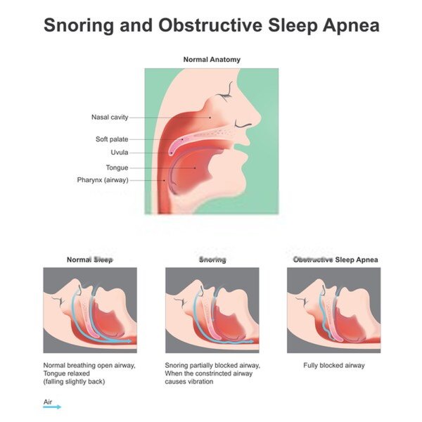 A graphic that shows common snorting and obstructive sleep apnea symptoms